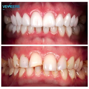 before and after veneers