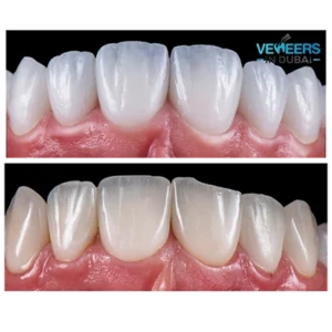 before and after porcelain