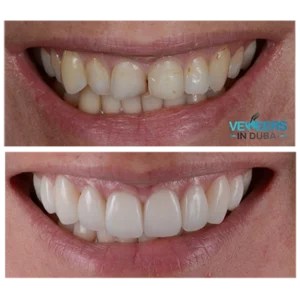 before and after Hollywood smile