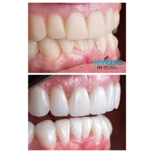 before and after veneers dubai