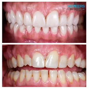 before and after amazing veneers